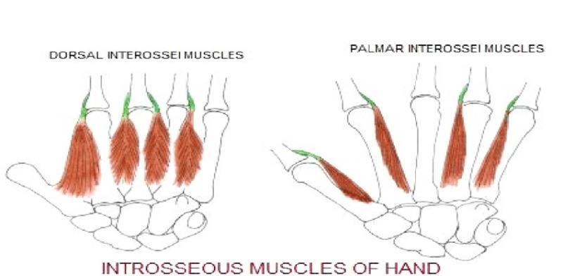 Figure 2. [Dorsal (A) and palmar (B)]. - GeneReviews® - NCBI Bookshelf