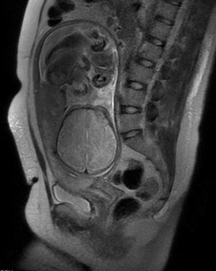 [Figure, MRI Maternal Placenta Previa Contributed by Scott Dulebohn, MD