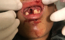 Tooth avulsion of an upper right central incisor