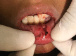 Deep laceration of lower lip after trauma