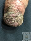 Verrucous Hyperplasia on Amputation Stump Contributed by Dr