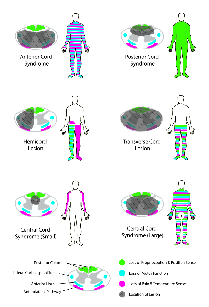 anterior cord syndrome