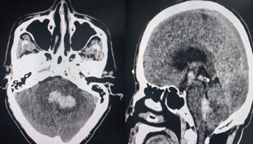 Figure Cerebellar Hematoma Contributed By Sunil Munakomi Md Statpearls Ncbi Bookshelf 