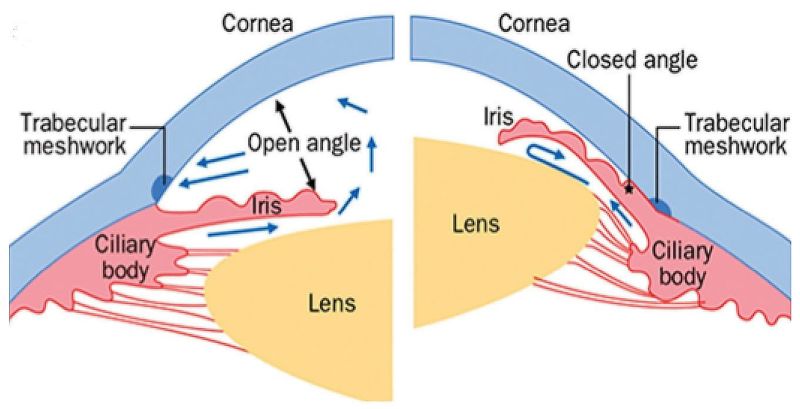 open angle glaucoma eye