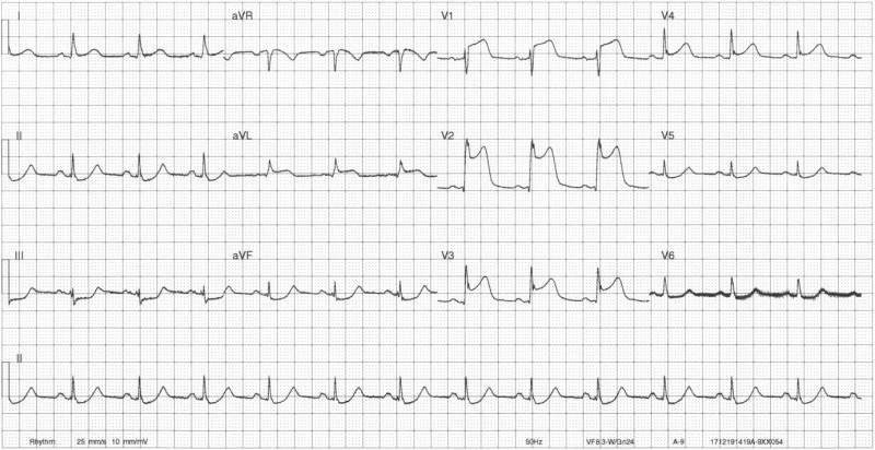ST Elevation without Infarction - RCEMLearning