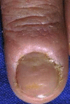 Figure, Tinea Pedis DermNet New Zealand] - StatPearls - NCBI Bookshelf