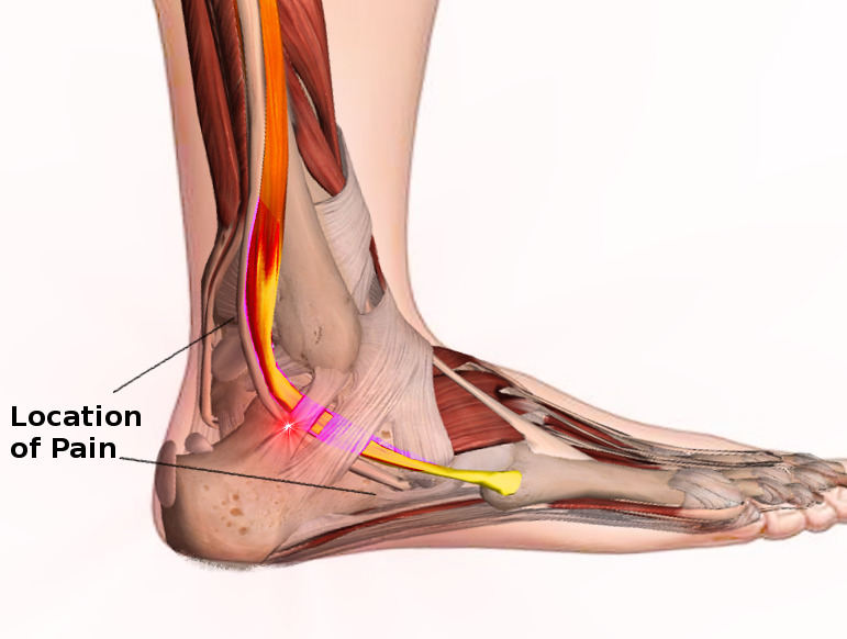 Figure Peroneal Tendon Syndromes Statpearls Ncbi Bookshelf