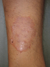 Tinea Corporis - Dermatology - Medbullets Step 1