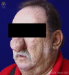 48-year-old male presents with difficulty breathing which has worsened over the last two years