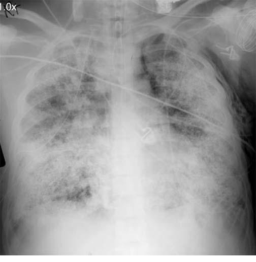 barotrauma lung