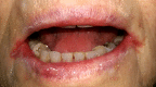 Angular cheilitis in elderly patient with false teeth, iron deficiency anemia and xerostomia