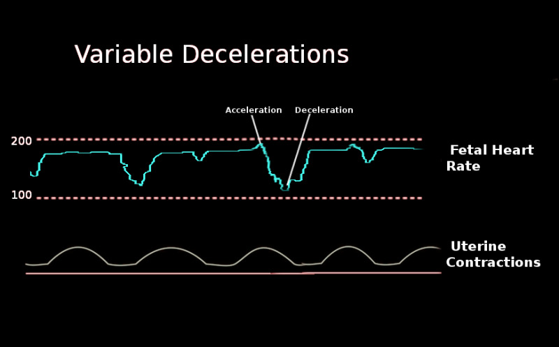 deceleration examples