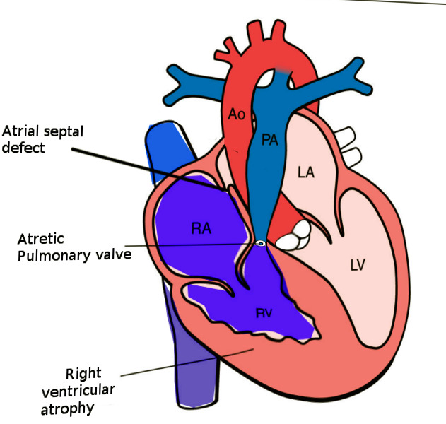 Figure, Pulmonary atresia with intact VS Image courtesy O
