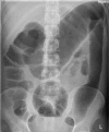 Toxic megacolon Contributed by WikiUser:Hellerhoff; (CC BY-SA 3