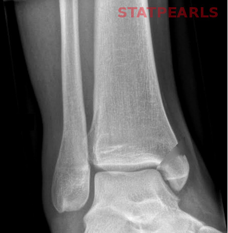 Figure, Ankle joint Image courtesy Dr Chaigasame] - StatPearls