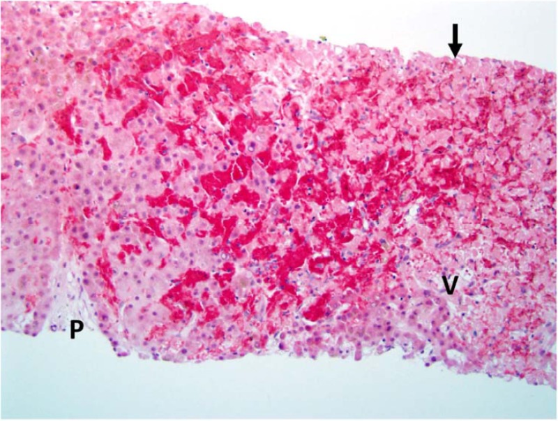 liver histology sinusoids