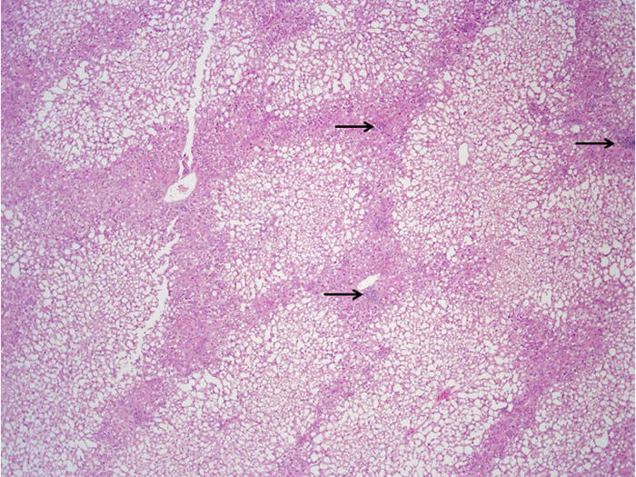 coagulative necrosis liver