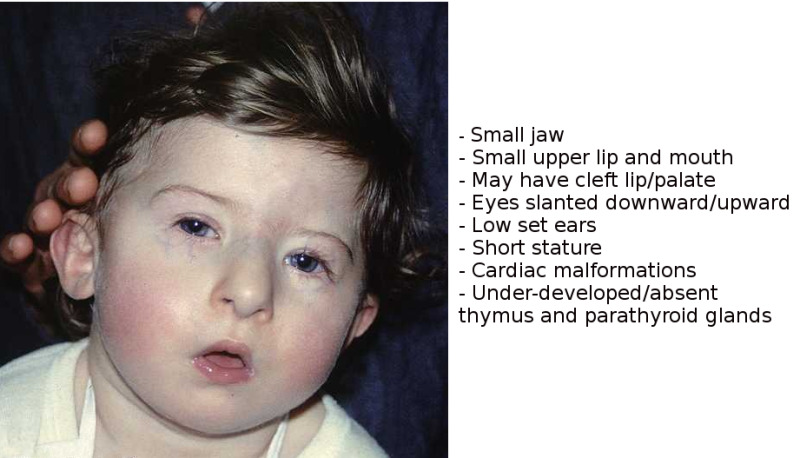 DiGeorge syndrome Contributed by Professor Victor Grech (CC By=S