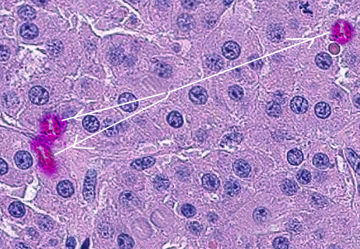 Figure Leydig Cell Tumor Image Courtesy S Bhimji Md Statpearls Ncbi Bookshelf 3053