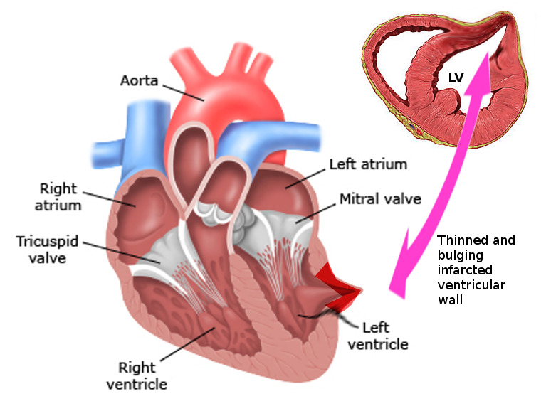 Image LV__pseudoaneurysm