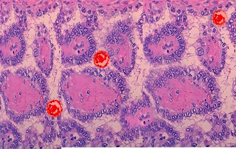 papillary thyroid cancer psammoma bodies