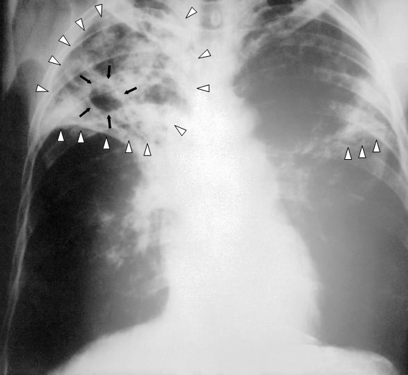tuberculosis vs pneumonia x ray