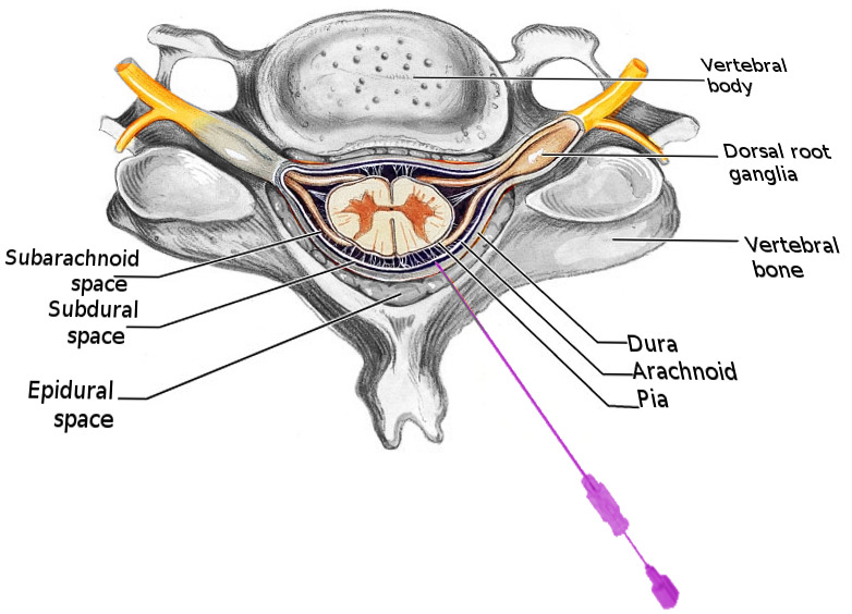 Figure Spinal Block Statpearls Ncbi Bookshelf 2208