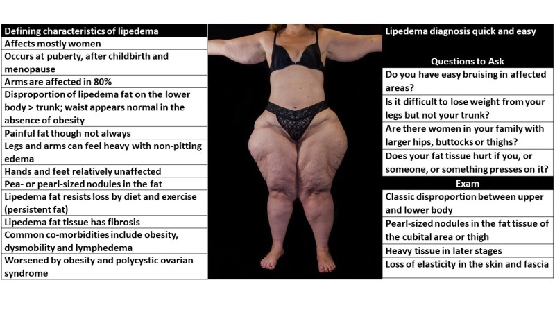 Stages and features of lipedema. (a) to (f): Front and back