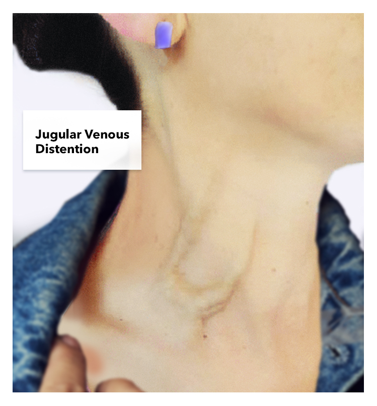 carotid versus jugular venous distention