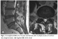 T2 weighted MRI of a 73 year old female with multiple levels of lumbar disc degeneration