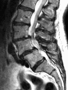 Sagittal MRI of Lumbar Spine With Spondylolisthesis at L3-4 and L4-5