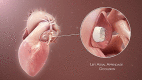 Illustration of left atrial appendage occlusion device used for stroke prevention in patients with atrial fibrillation Scientific Animations, CC BY-SA 4
