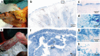 Fig. 1. Histopathological analysis of tissue from two patients excised 6 and 8 weeks respectively after SR8 treatment respectively.