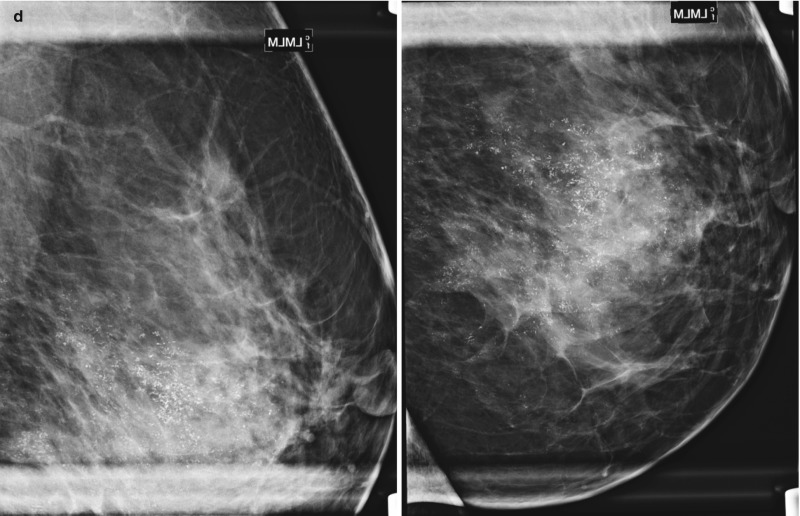 Fig 13 2 [multicentric Invasive Ductal Carcinoma Iii ] Diseases Of The Chest Breast