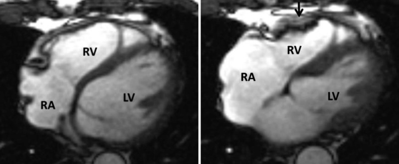 The uniqueness of cardiac magnetic resonance imaging in arrhythmogenic  right ventricular cardiomyopathy