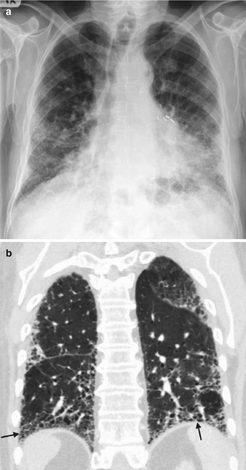 interstitial pneumonia x ray