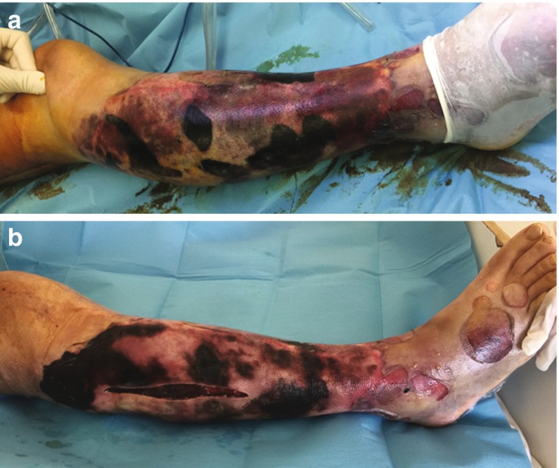 Fig. 9.1, [(a) A 42-year-old man with]. - Compartment Syndrome - NCBI  Bookshelf