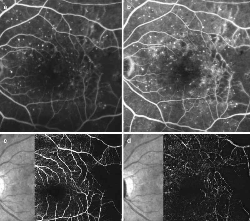 Fig 6 8 [multimodal Imaging Of Diabetic Retinopathy ] High