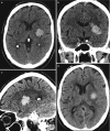 Fig. 5.1. Hypertensive hematoma.