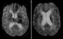 Fig. 5.3. Hypertensive microhemorrhages.