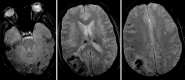 Fig. 5.4. Cerebral amyloid angiopathy (CAA) microhemorrhages.