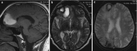 Fig. 5.5. Cerebral amyloid angiopathy (CAA).