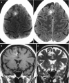 Fig. 5.6. Cavernoma.