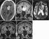 Fig. 5.7. Hemorrhagic tumor.