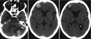 Fig. 5.8. Acquired coagulopathy associated brain hemorrhages.