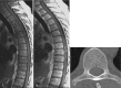 Fig. 6.13. Sagittal pre- (a) and post-contrast-enhancing T1-weighted (b) images over the thoracic spine demonstrating lesions in the vertebral bodies and discrete contrast enhancement in the spinal cord at the level of the mid-thoracic region.