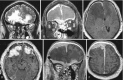 Fig. 6.14. Thick, dural enhancement is observed bilaterally frontally and along the falx (b–f).