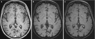 Fig. 6.18. On post-contrast T1wi, enhancement of the branches of the left posterior cerebral artery is noted (a).