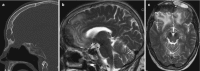 Fig. 6.20. (a) Sagittal CT (bone window) demonstrates opacification of the frontal sinus.