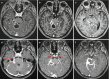 Fig. 6.5. Proven tuberculous meningitis with multiple ring-enhancing tuberculomas in the basal cistern (a–c).